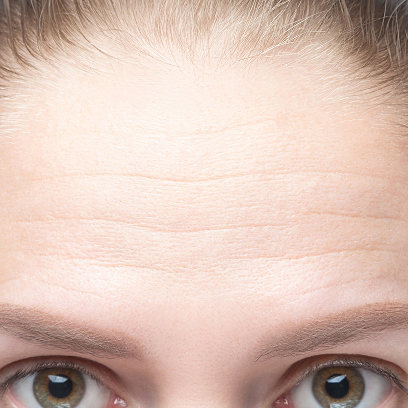 Frontalis horizontal forehead lines